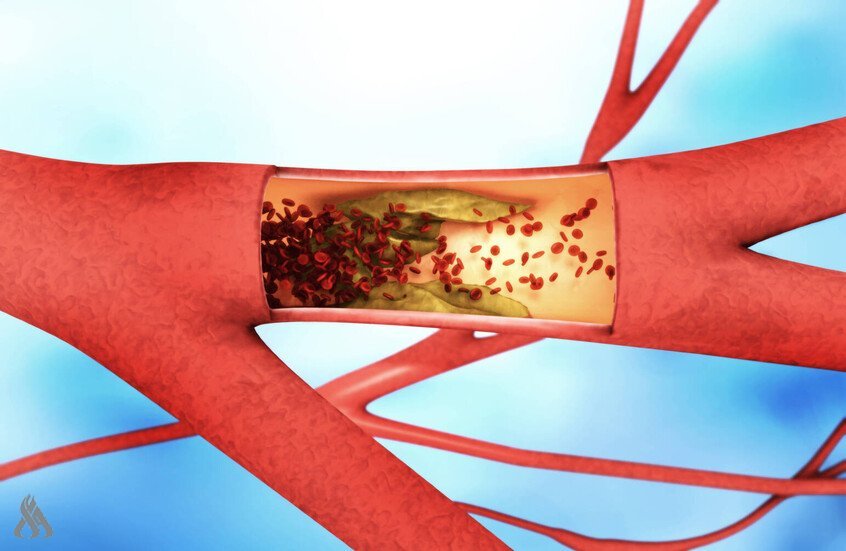 آلية-جديدة-تفسر-كيف-تتحول-الدهون-إلى-لويحات-داخل-الشرايين.jpg